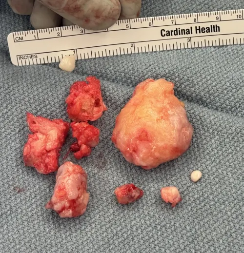All the bone spurs removed from my mother’s elbows. Largest was 4cm, or about the size of a golf ball.