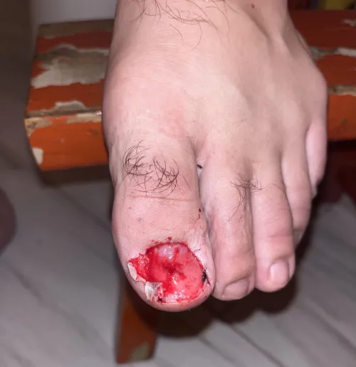 full big toenail avulsion