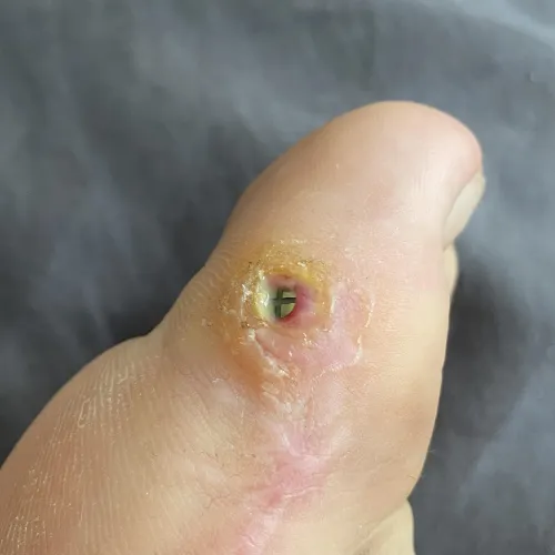 I thought it’s just a toe callus