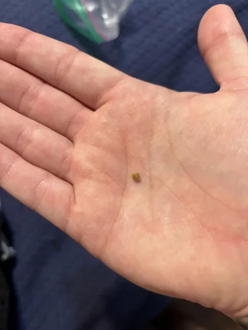 Passed this kidney stone this morning