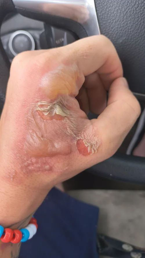 Should I go to the ER?