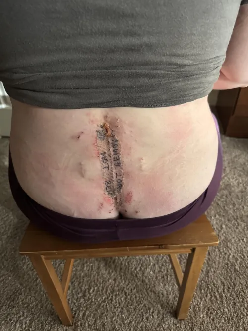 Spinal fusion, had an allergic reaction to the tape