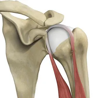 Proximal Bicep Tendon Rupture  - What are your suggestions to speed recovery?