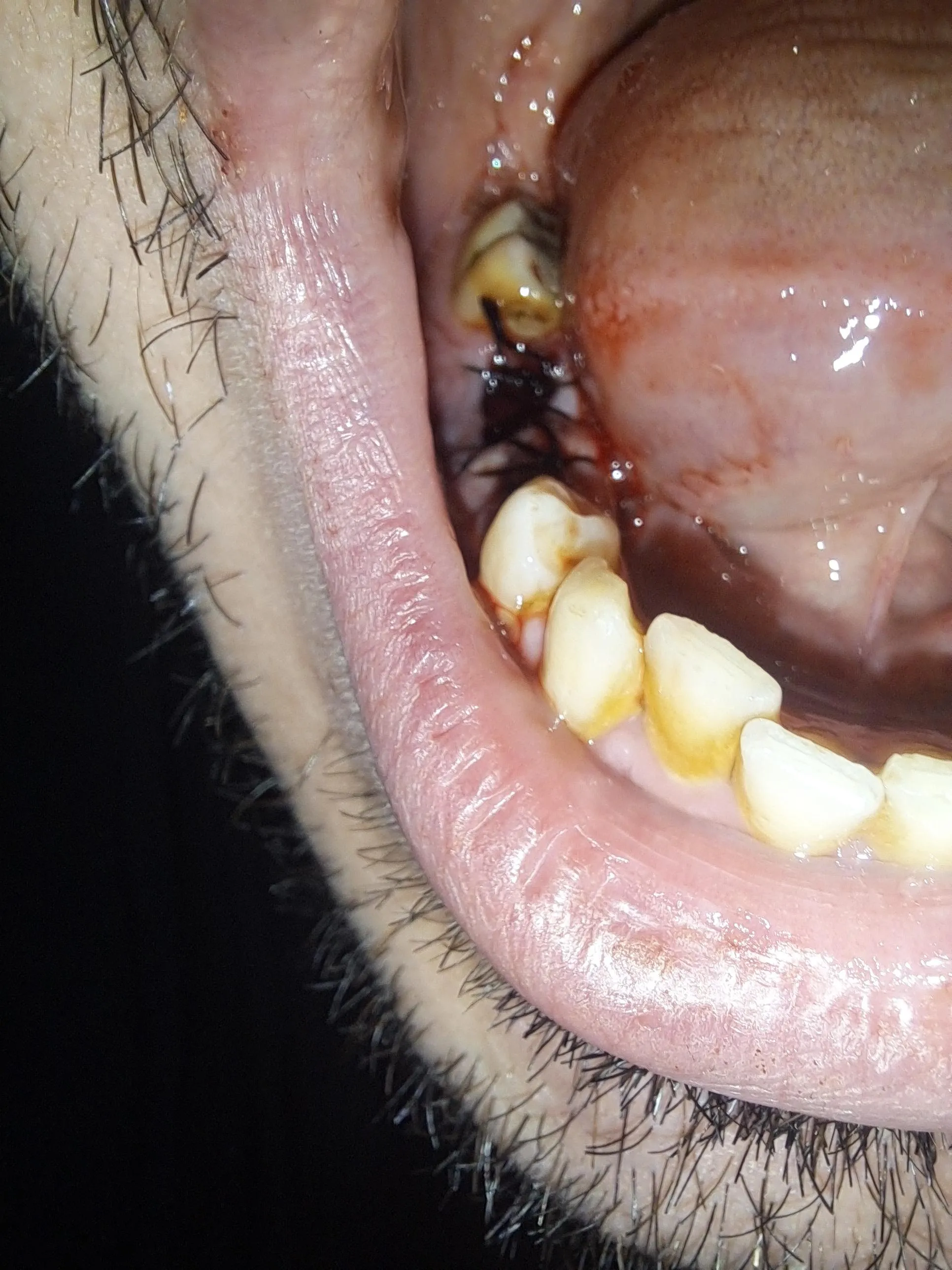 Dental Stitches 😬 take good care of your teeth folks