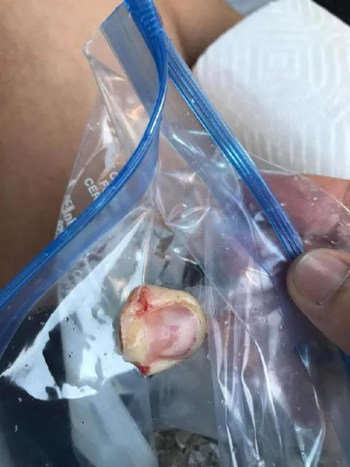 Friend put his finger in the hitch while trying to load an RV onto the truck.