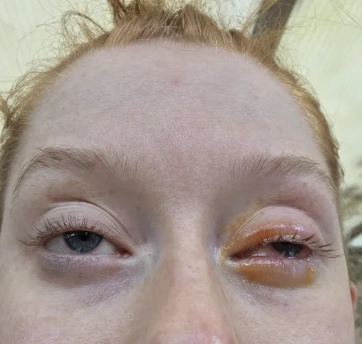 Got a scratch on my cornea