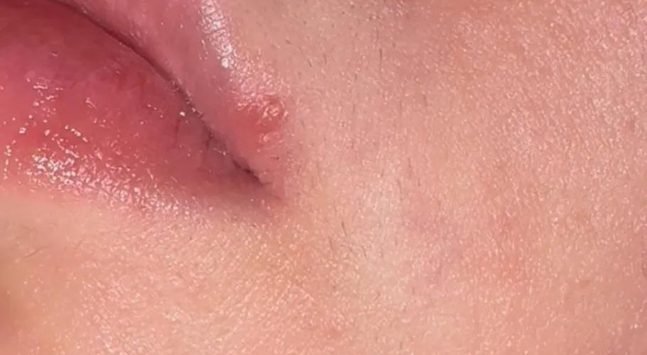 Is this a cold sore?? Never had one before and worried it might be