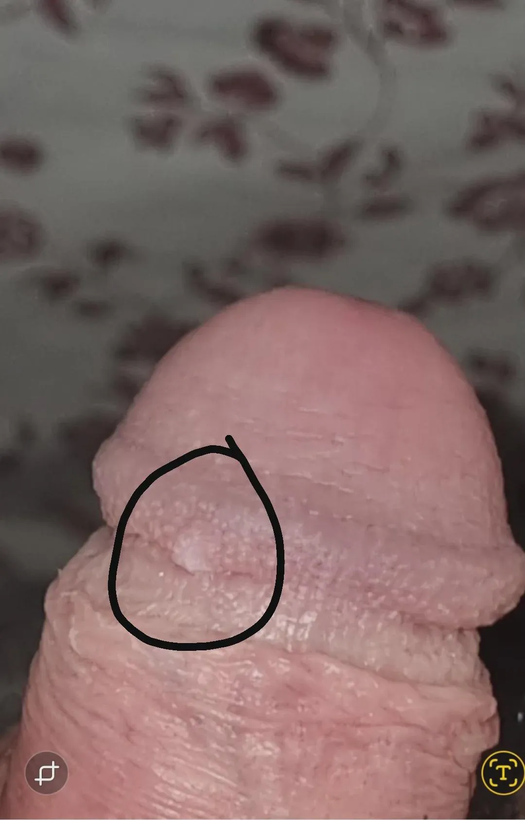 Small white bump on penis? Balanitis? Other irritation? Will this resolve on its own? (30m)