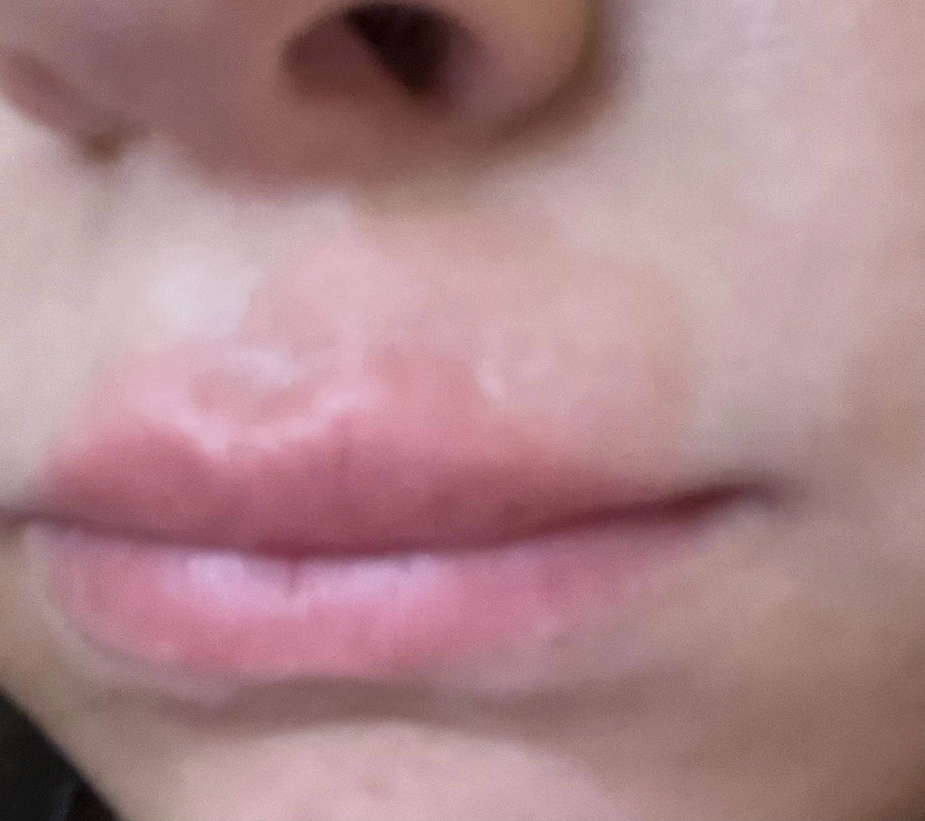Sore on my lip thats been here for months, wont go away no matter what i try. Any advice?
