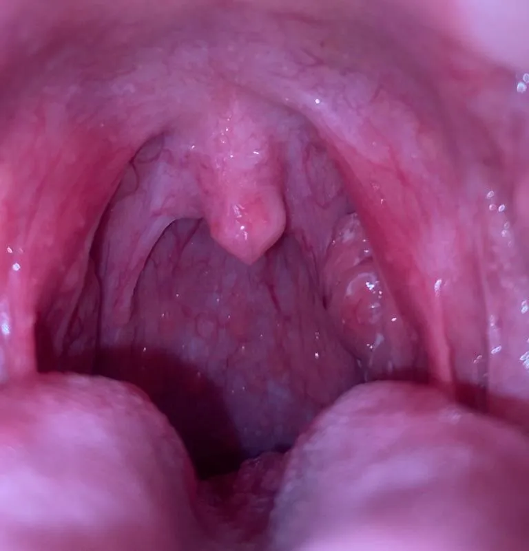 Throat in front of tonsils has been hurting for about 5 days //////