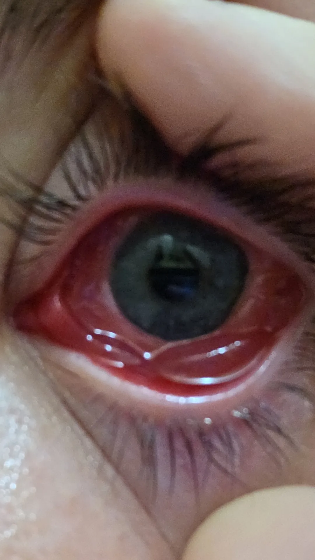 My eye with pink eye and another infection. Yes I am on antibiotics. I'm just not sure they're working.