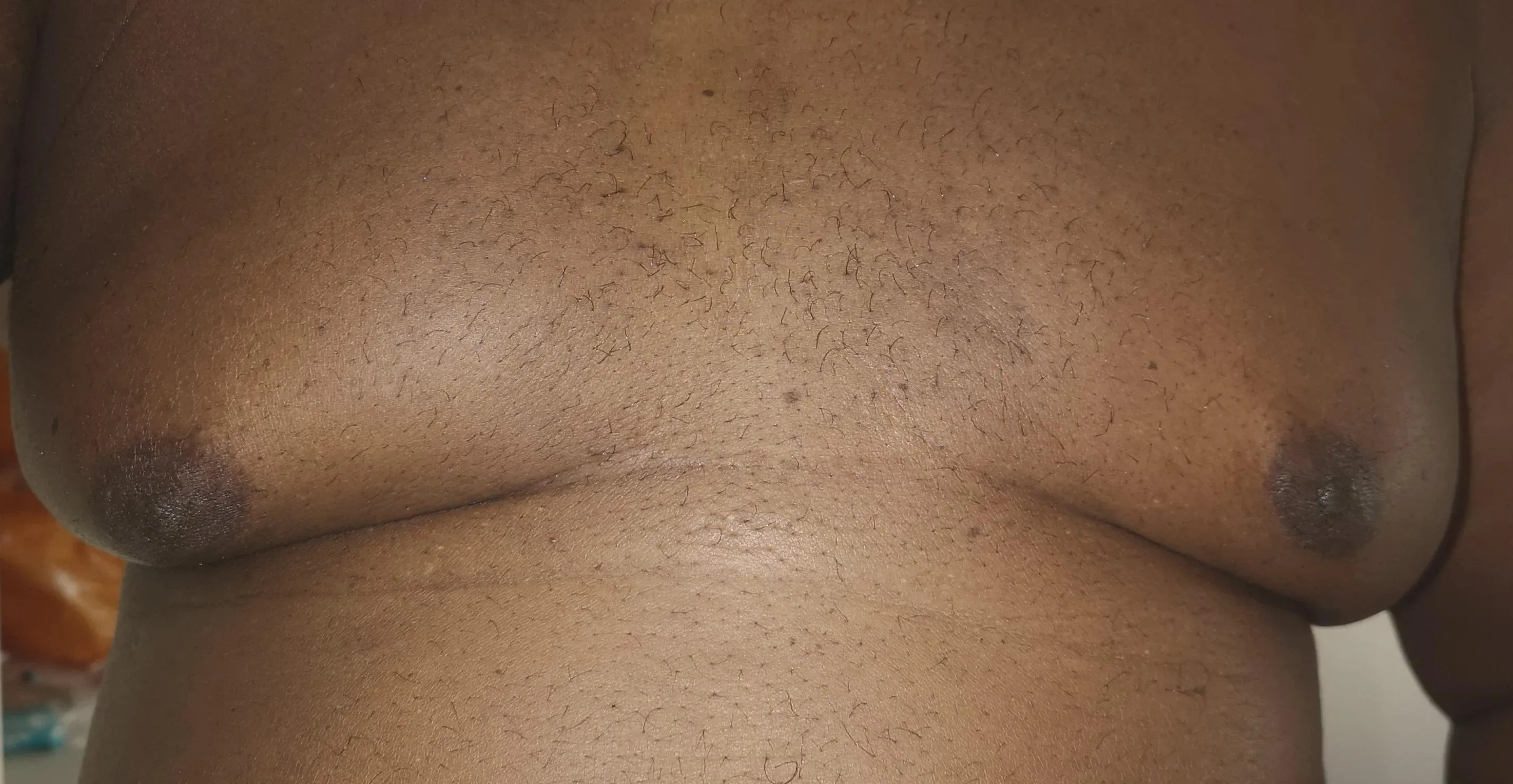 Started Lyllana estradiol 0.1mg patches today