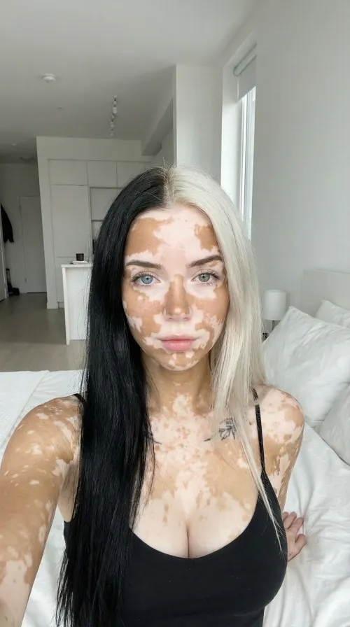 Do I look good even with my skin condition?