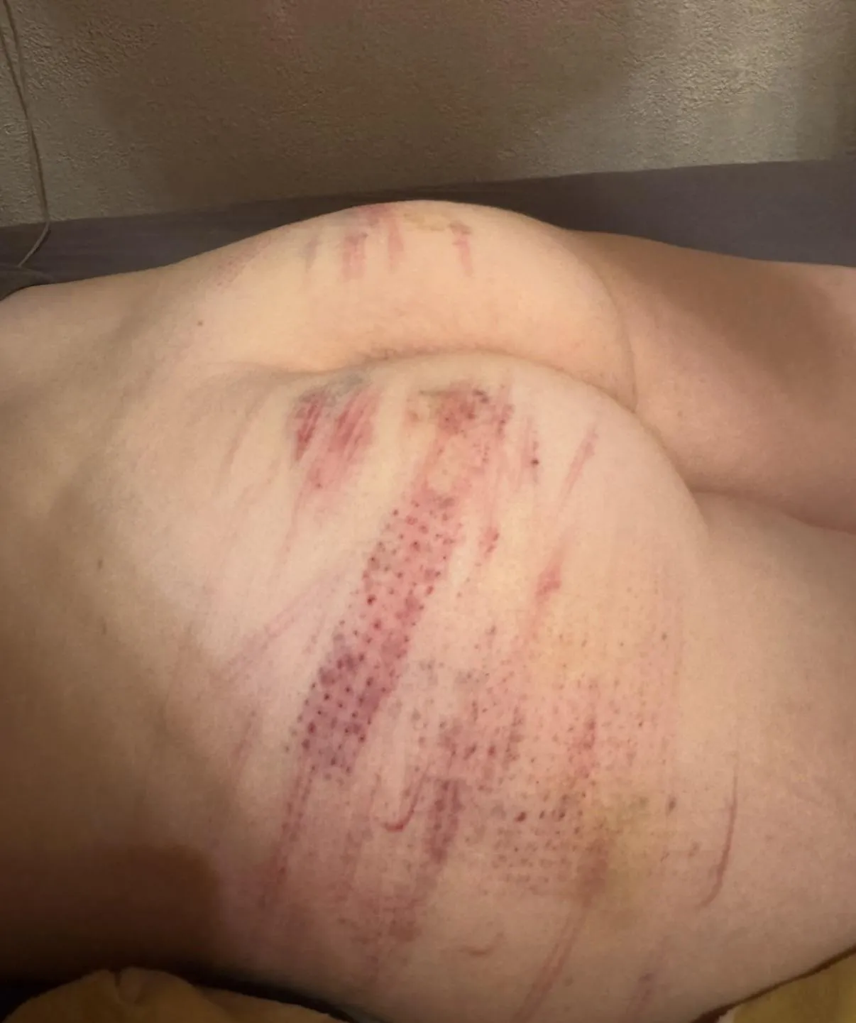 Aftermath of a rough spanking session