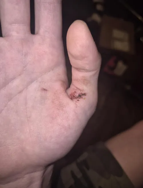 1 Week update on glass injury