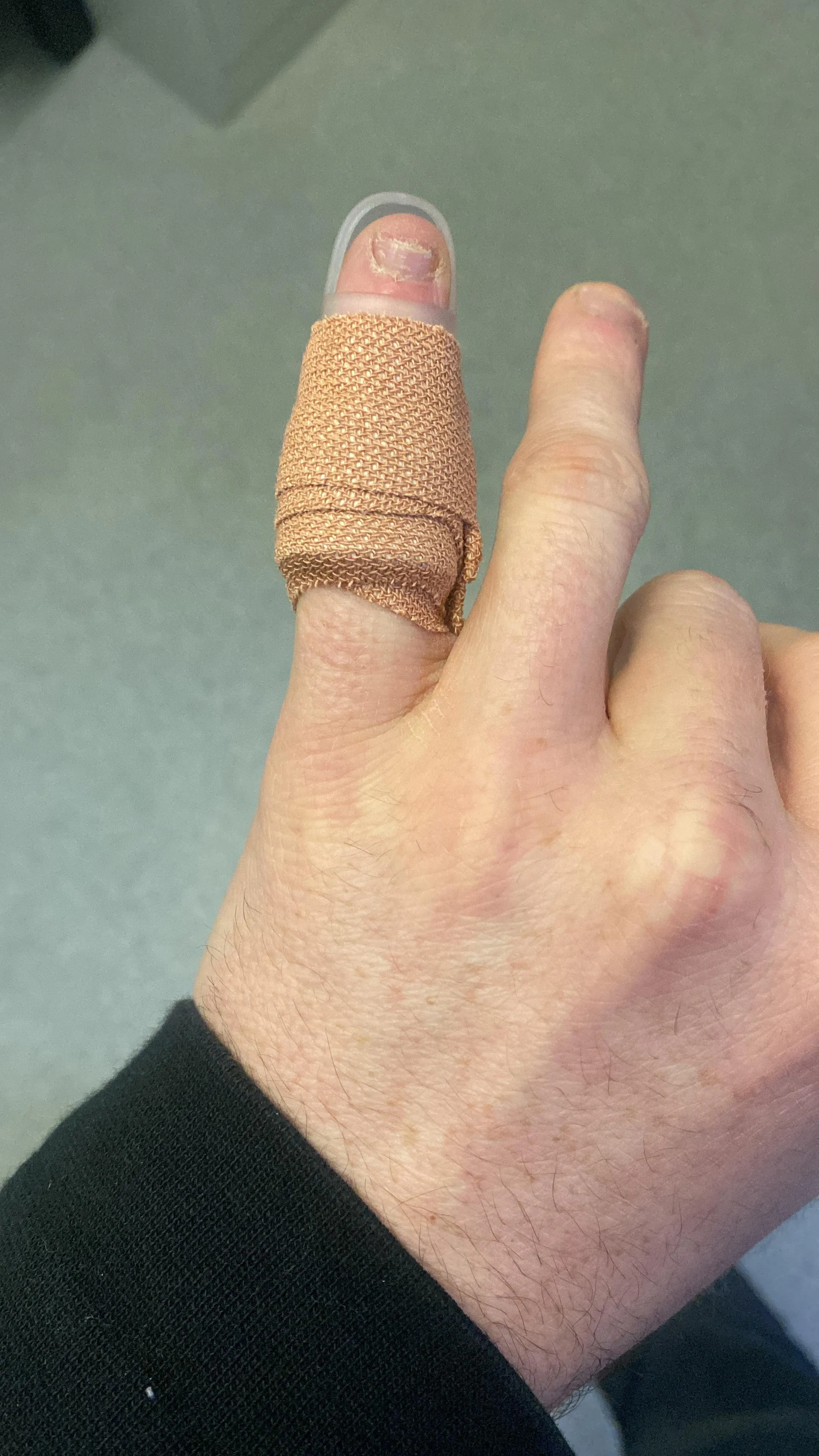 Anyone have experience with Mallet Finger?