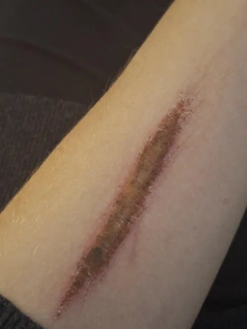 Is it ment to be this colour when healing?