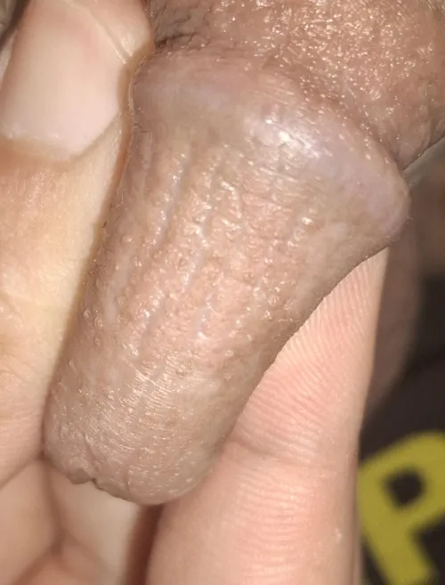 Severely thickened / keratinized penile skin with loss of sexual sensitivity – need real experiences