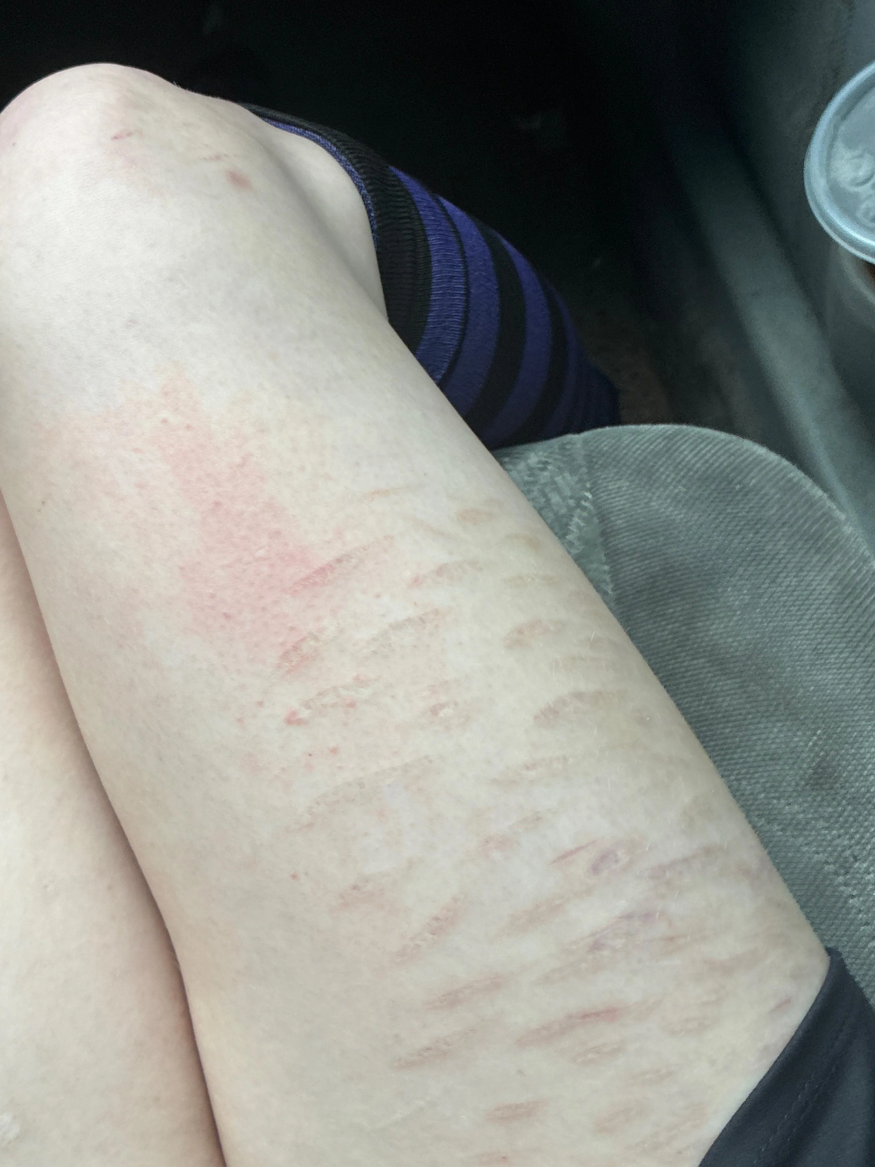 Thigh and knee scars :3