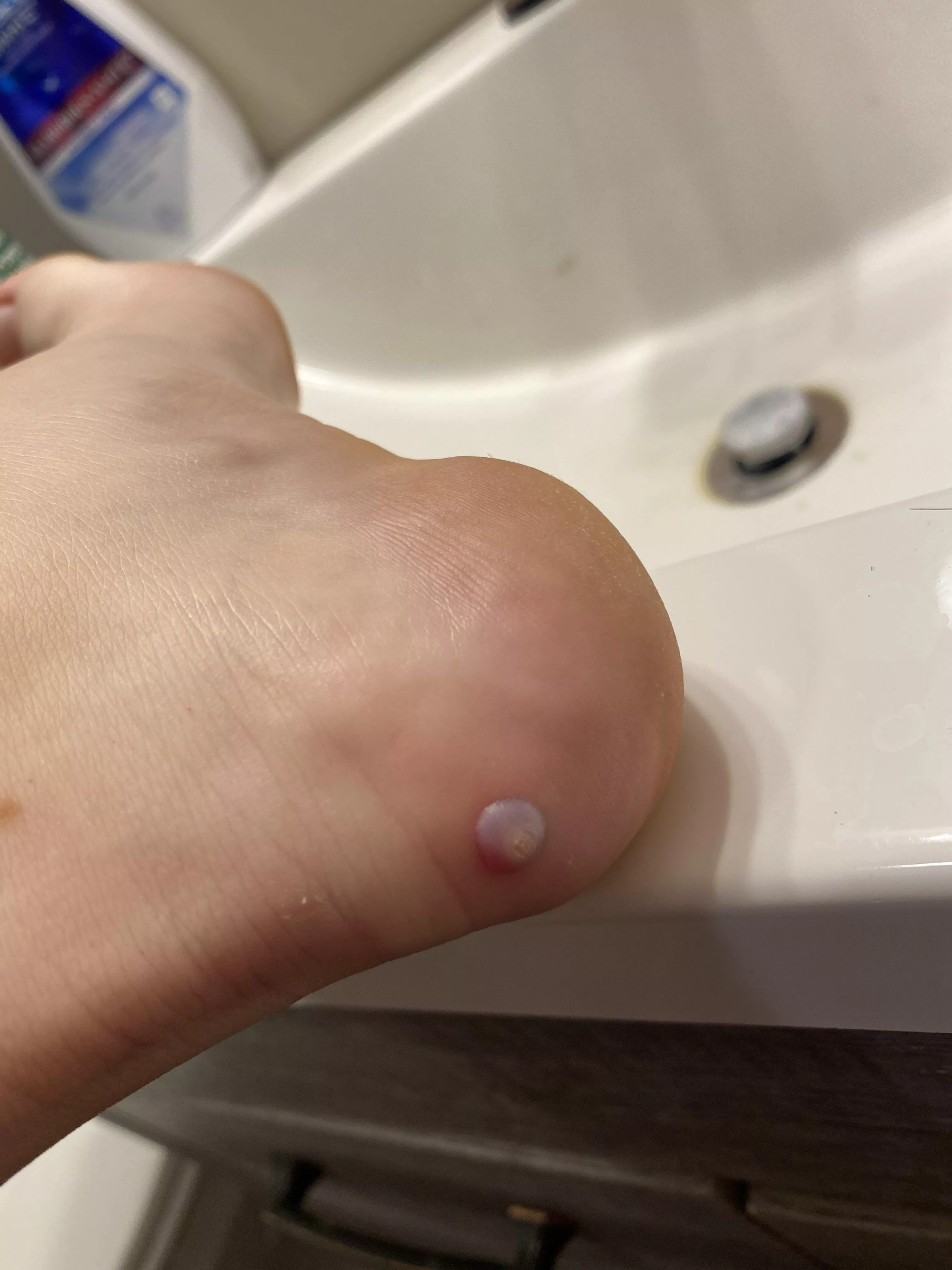 Should have taken the day off of the gym after having this wart frozen. So tempted to give it a little poke.