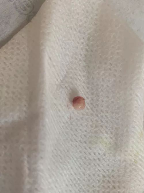 A scalp cyst removed at the dermatologist today. About the size of a tic tac.