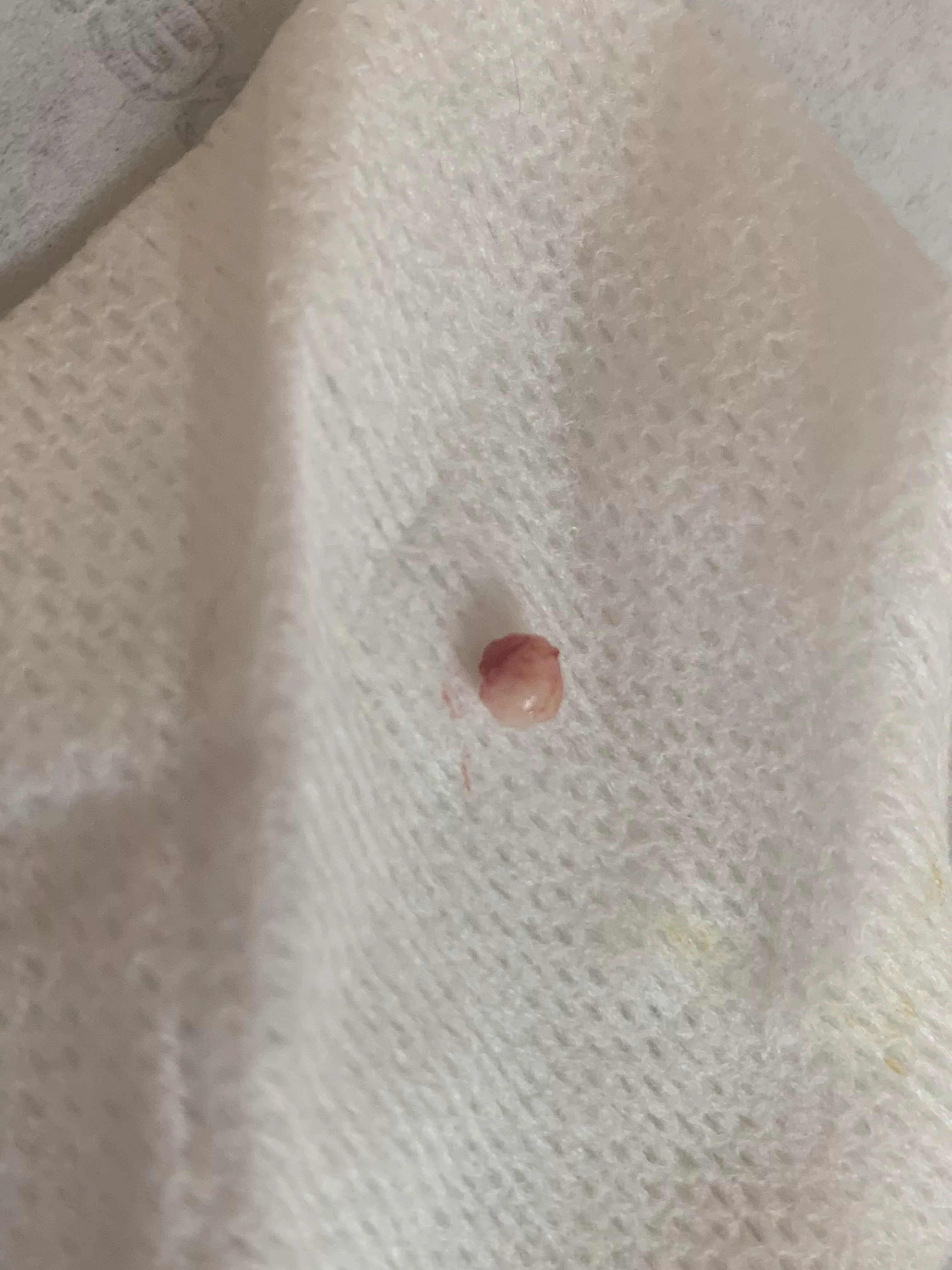 A scalp cyst removed at the dermatologist today. About the size of a tic tac.