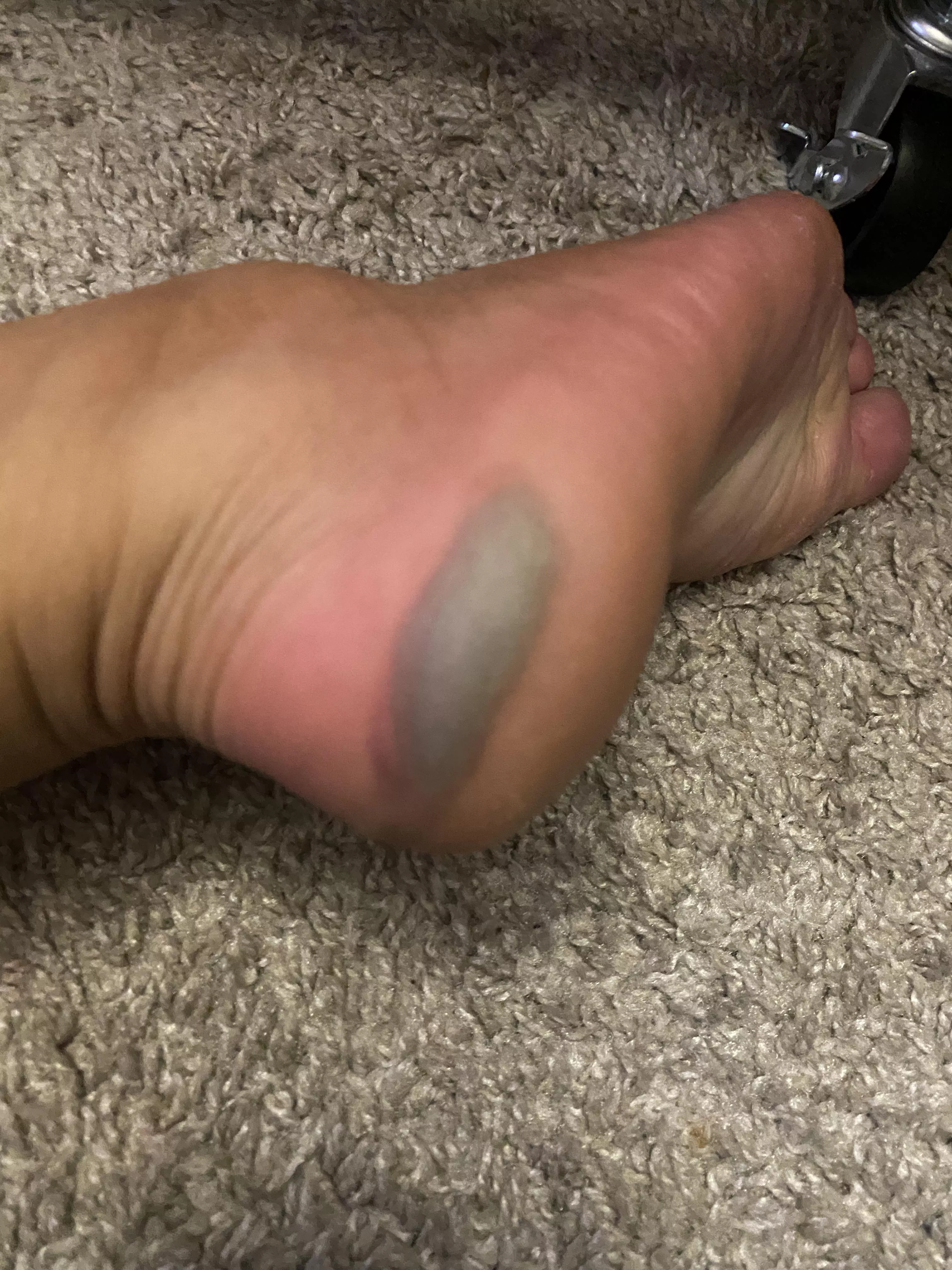 Wore the wrong shoes and paid for it. Both feet are like this 😭