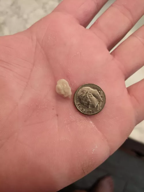 tonsil stone I got out today