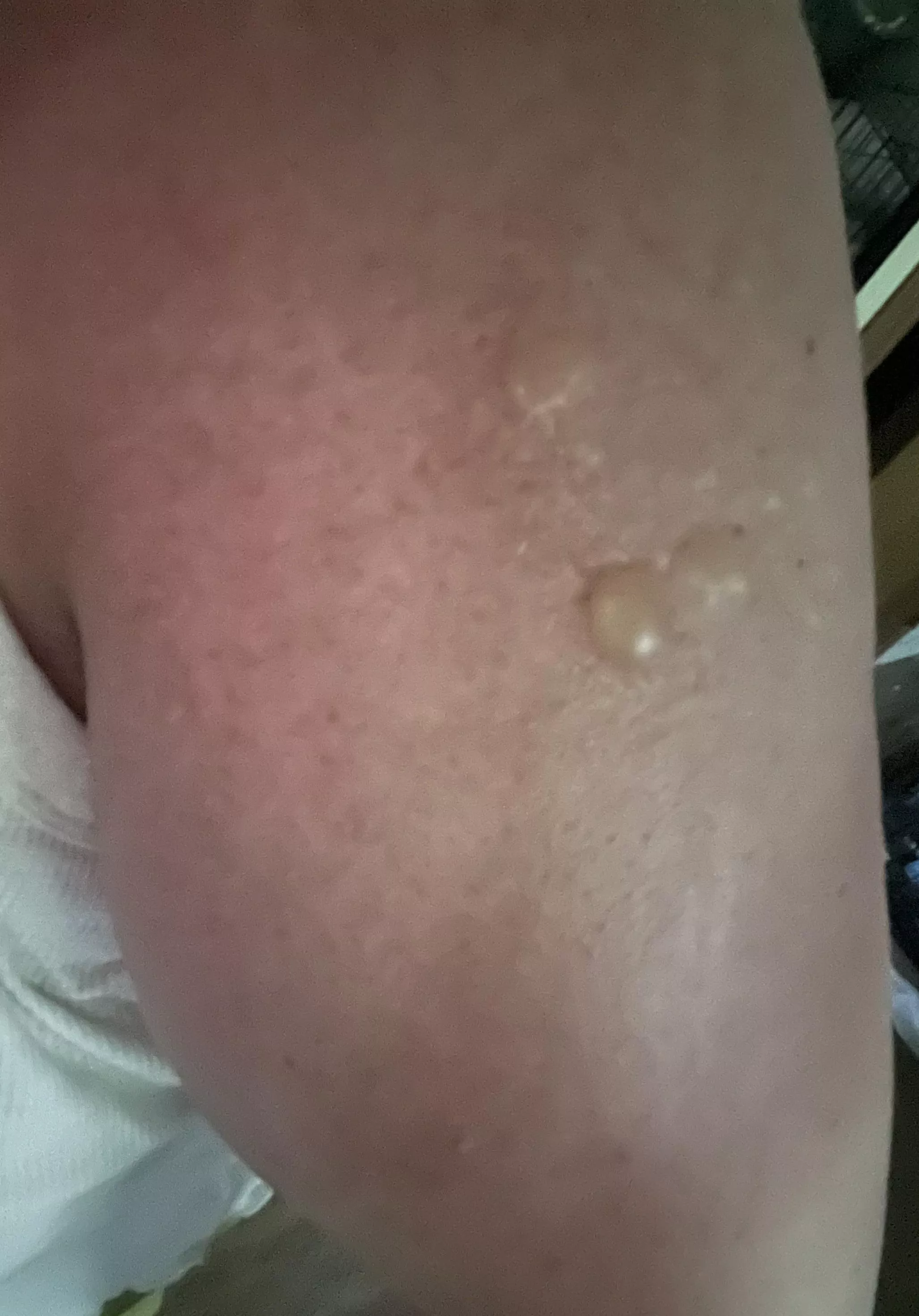 Wear sunscreen if you’re a pale homebody. I know I shouldn’t pop and frankly in too much pain to reach it to pop it!