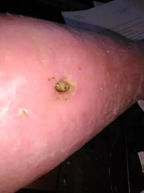 My moms abscess on her leg that I keep telling her needs antibiotics. She has some health problems and her legs have been so swollen for the past couple years and now this has been going on for the past couple months and she isn’t the greatest at getti