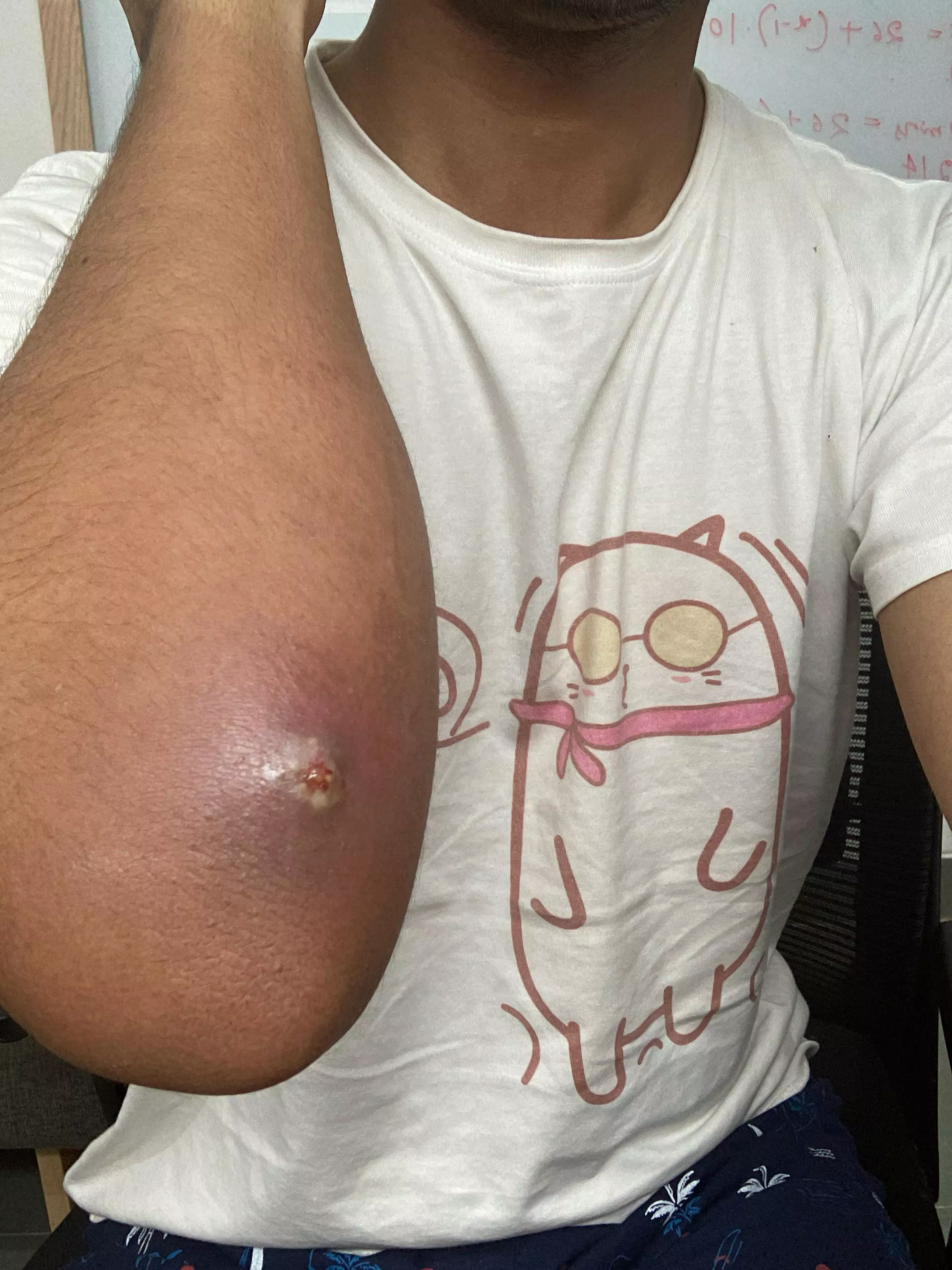 So tempted to pop this but it’s extremely painful. And I’m afraid the infection might spread.