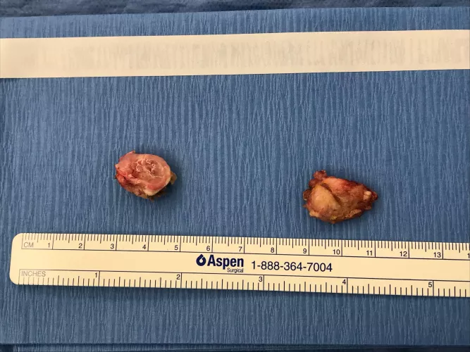 Tonsil Removal - Dr said the left one came with some stones. I was never able to pop them. But the right one was clean cause I could pop it.