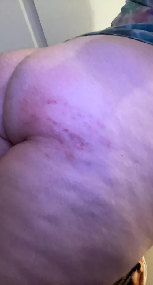 A mark I was left with last night 😋