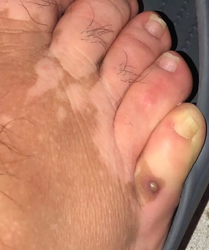 Scared. Is this Boil or MRSA or Staph?