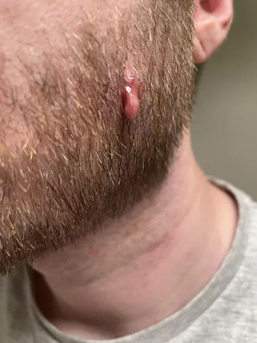 This just came out of a birthmark, should i be worried?