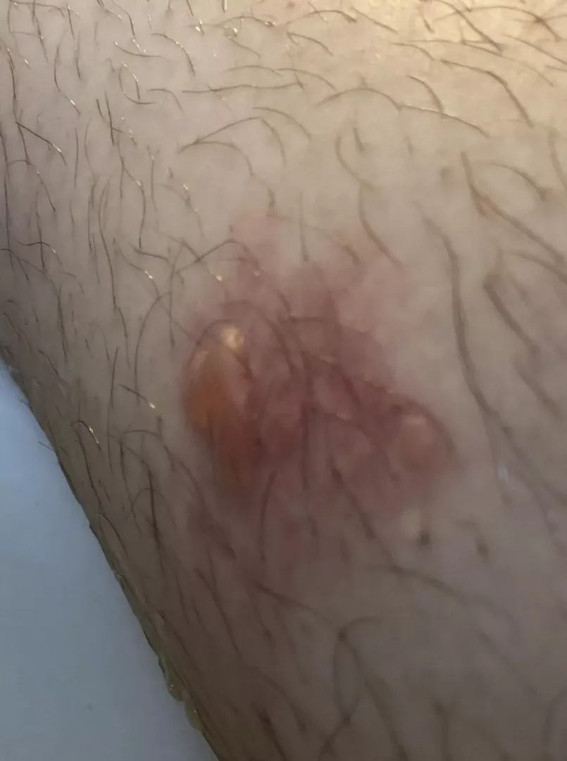 Forbidden pop - juicy leg blister from the tail pipe on my friends bike