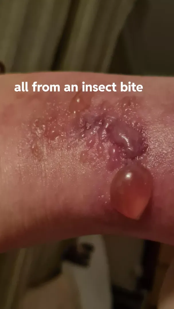blistering bite from a small garden flea. I ended up in A&E on IV Antibiotics last time.