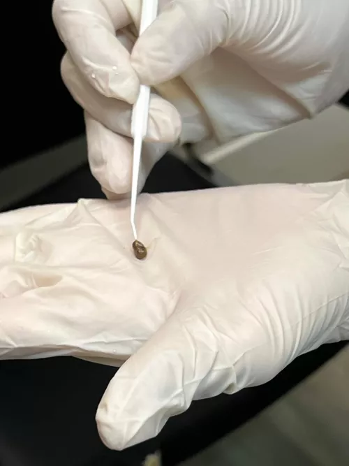 Pediatrician thought my daughter had impacted earwax. Turns out it was a pebble in her ear.