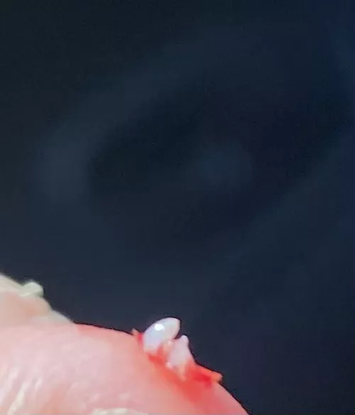 I get these plugs under my facial skin that cause pimples that won’t heal until i pull them out. What are they?! Literally the pimples last for weeks.