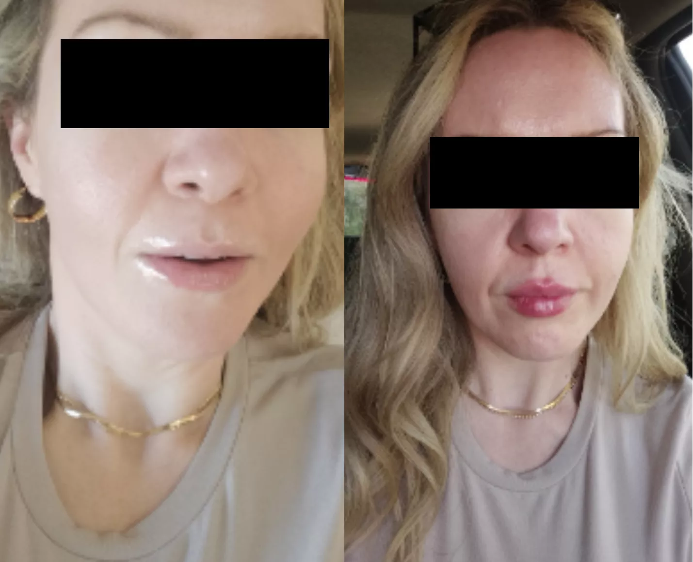 Ongoing bimbofication of my (37F) wife - previously 1650cc implants, now first size upgrade on lips (1 vial)