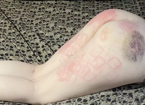 She wouldn’t stop begging me to show everyone her welts and bruises