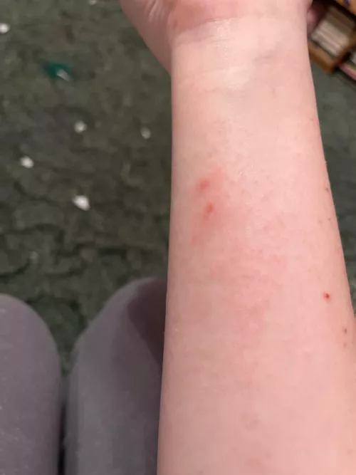 Long time lurker first time poster. Got poison Ivy on me. Definitely a forbidden pop