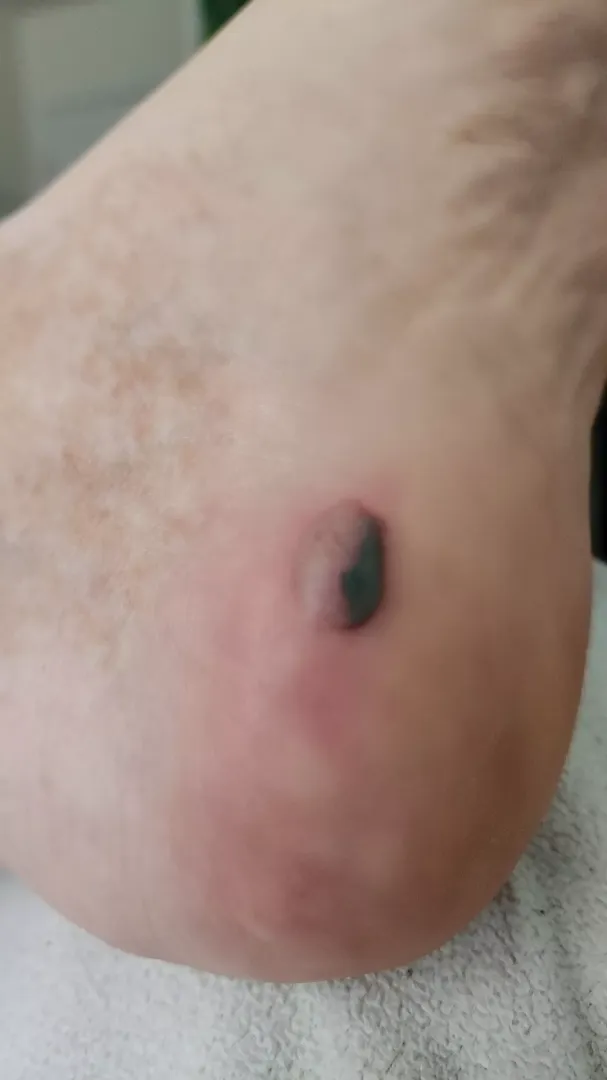 I've never had a foot blister this bad, how do I treat it? I have work in 3 days :(