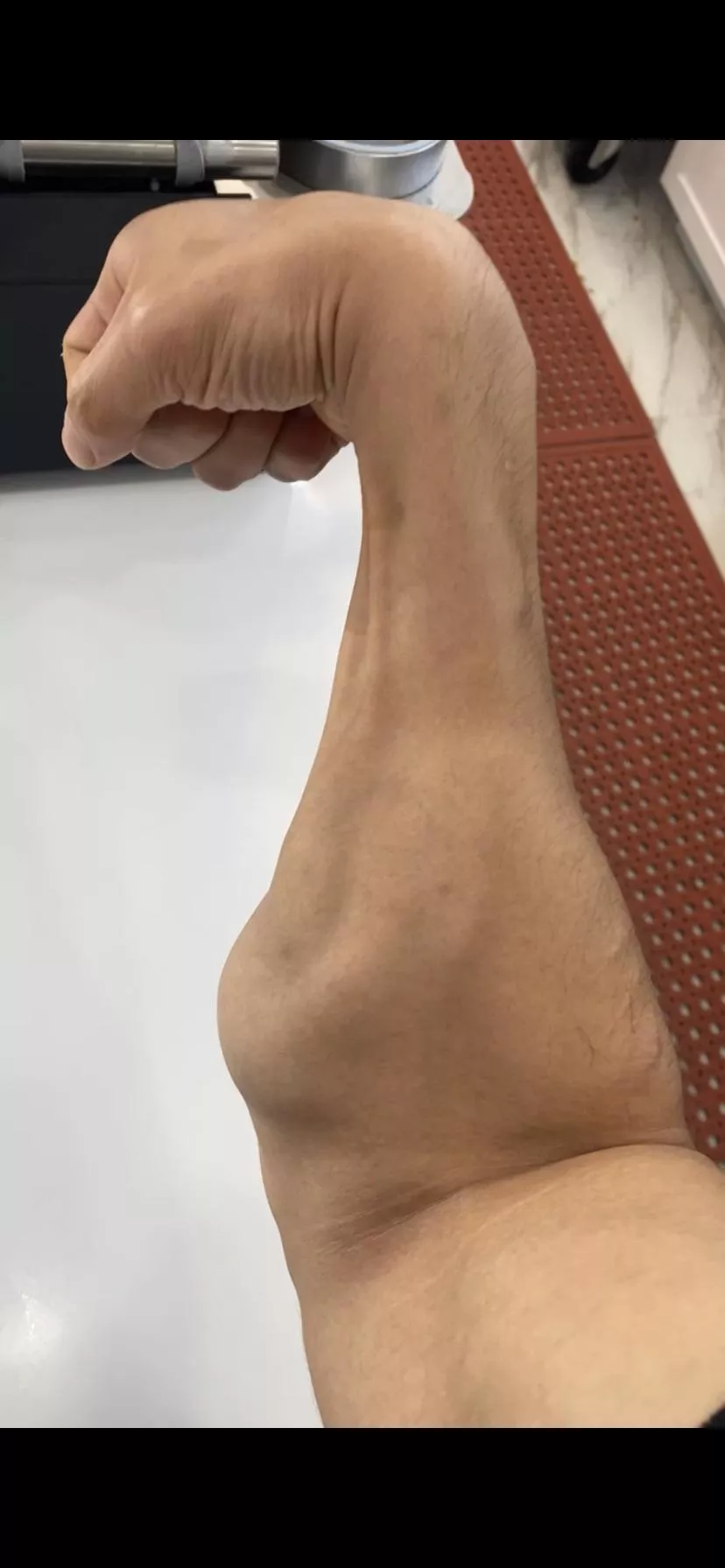 Uneven forearm ! Is this normal ? I hardly train my forearm somehow it’s been keep getting bigger
