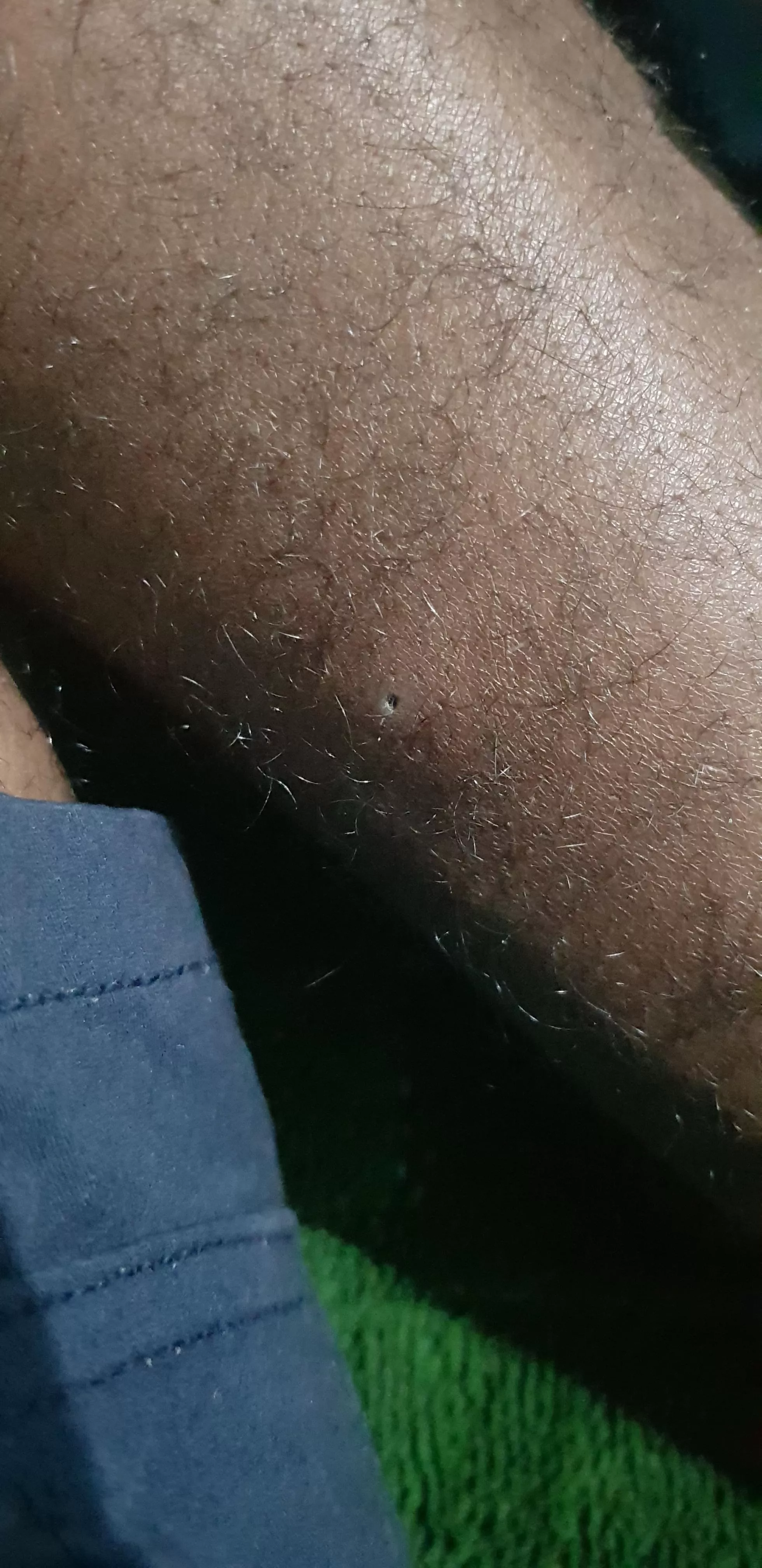 just discovered this on my calf, looked like a scab till i started squizing/picking, whats it? a hole?