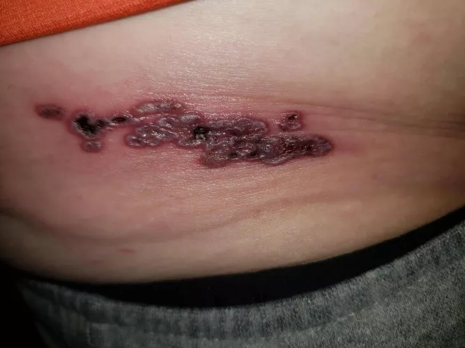 Update on my forbidden pops cluster: really &@#%$^& hurts