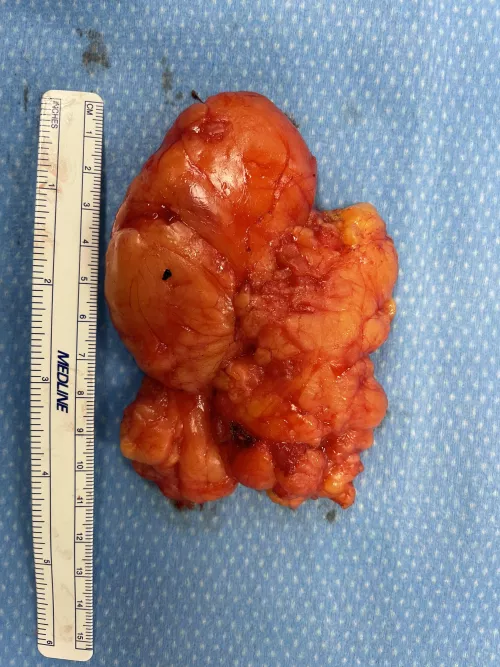 I see your arm relief and your hip bump and raise you my back lipoma.