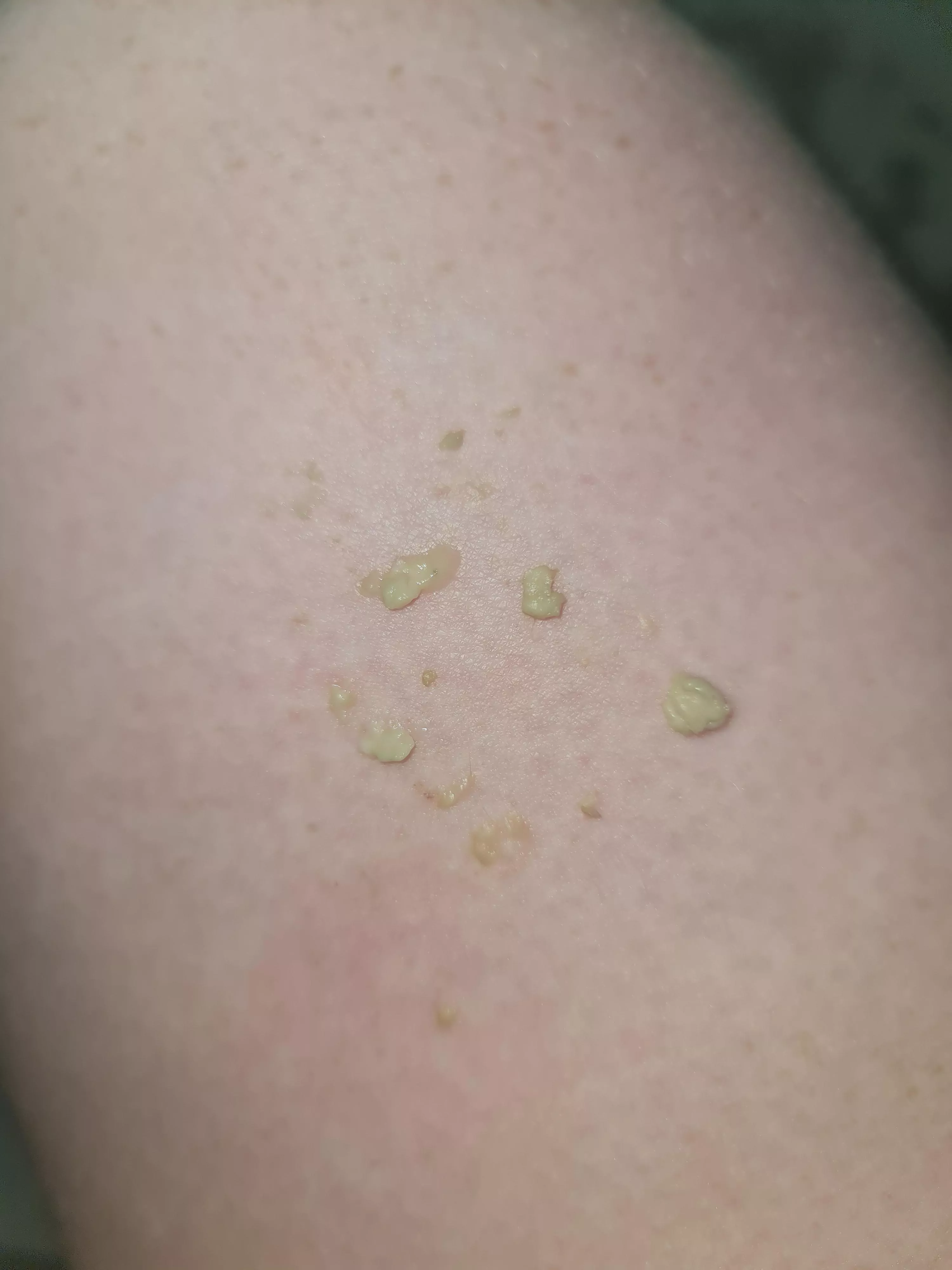 This all came out of my ear - still some left.