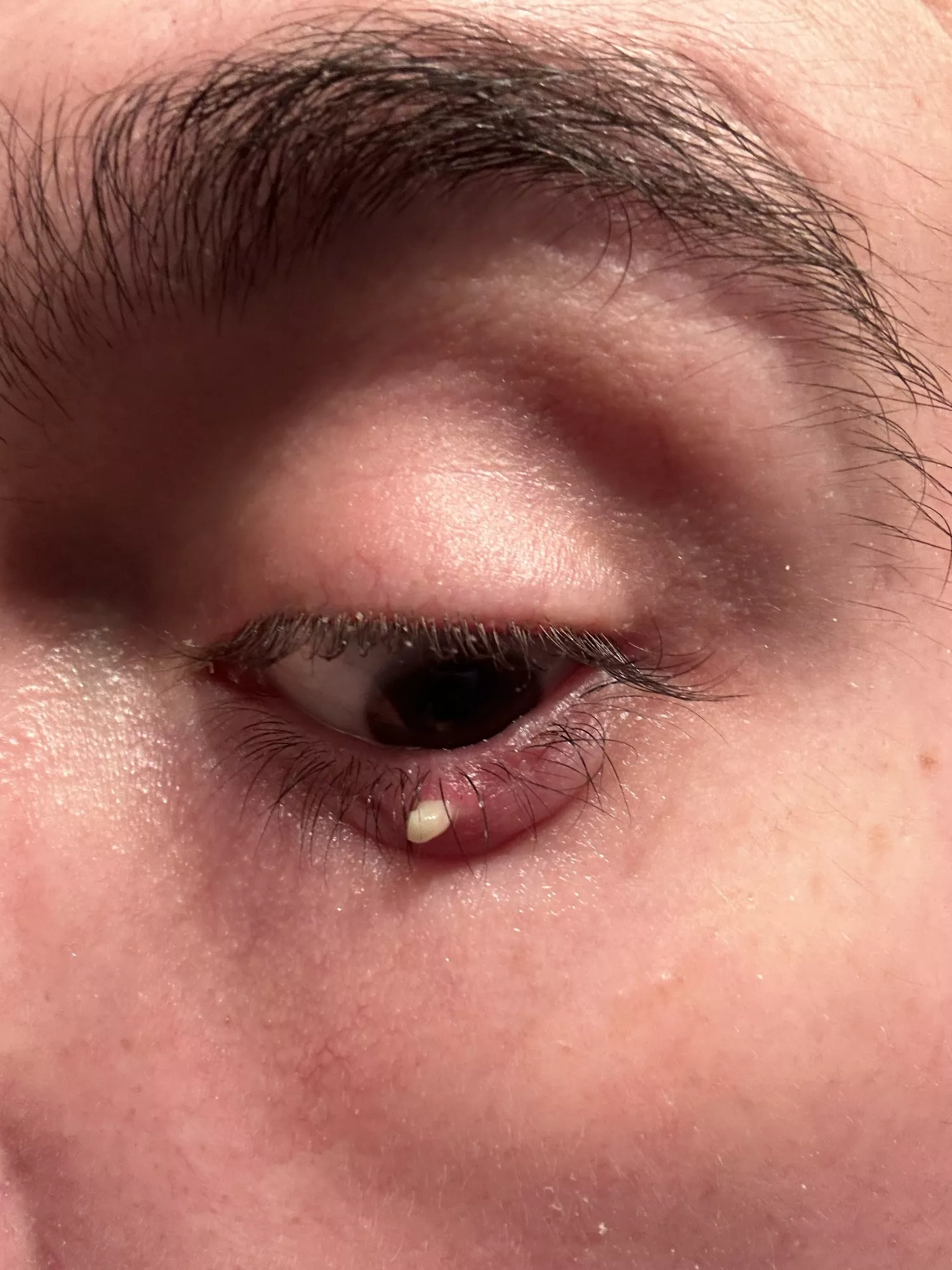 My chalazion finally gave out