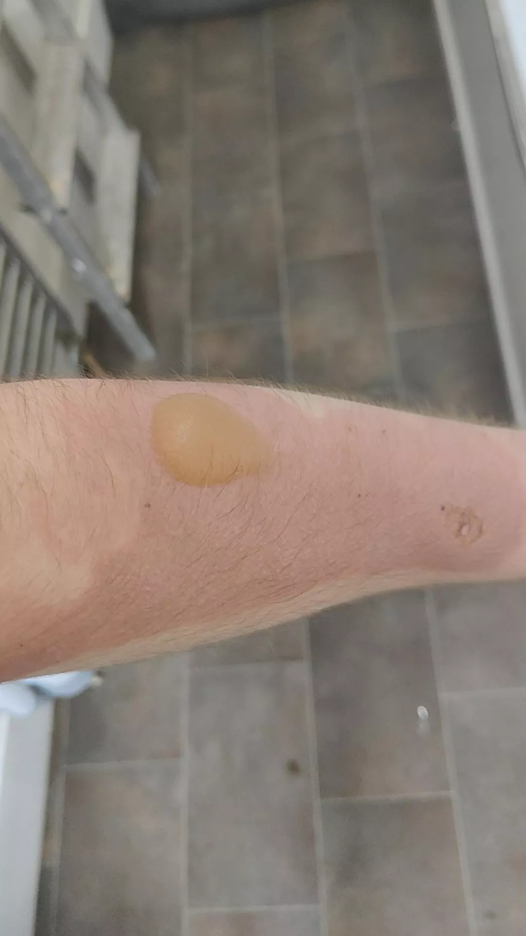 got a pretty bad burn the other day because I spilled a hot water bottle it was tiny yesterday and I woke up with this